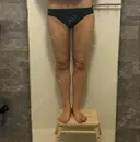 脂肪吸引（脚） 湘南美容クリニック 京都院 DAY 41 サムネイル用