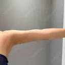 脂肪吸引（二の腕） / 脂肪吸引（お腹） / 脂肪吸引（腰） Mods Clinic（モッズクリニック） 東京院 DAY 92 サムネイル用