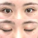 二重切開 つだ美容外科クリニック AFTER サムネイル用