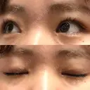 目頭切開 湘南美容クリニック 大阪心斎橋院 DAY 60 サムネイル用