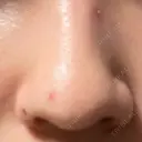 ほくろ・いぼ除去レーザー（肌） Fellez Clinic【フェルズクリニック】 AFTER サムネイル用