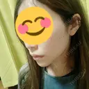 ボトックス（あご） / ヒアルロン酸注入（あご） 高崎TAクリニック DAY 2 サムネイル用