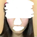 糸リフト / 脂肪吸引（顔） / ジョールファット除去 / ボトックス（エラ・小顔） ルラ美容クリニック 新宿院 DAY 127 サムネイル用