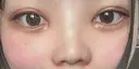 二重埋没 / 目頭切開 / 鼻尖形成（切開） / 軟骨移植 / 眉間プロテーゼ / 鼻尖縮小 グローバルビューティークリニック 大阪院 DAY 8 サムネイル用