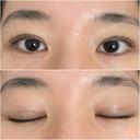 二重埋没 オアシス美容外科 DAY 6 サムネイル用