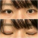 二重埋没 オアシス美容外科 DAY 7 サムネイル用