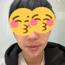 ボトックス（あご） / ヒアルロン酸注入（あご） / ヒアルロン酸注入（鼻翼基部） シェリークリニック 新宿本院 DAY 0 サムネイル用