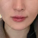 ヒアルロン酸注入（あご） 松倉クリニック 表参道 AFTER サムネイル用