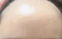 ヒアルロン酸注入（額） 品川美容外科 品川院 AFTER サムネイル用