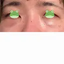 クマ治療 / 脂肪注入（肌） X CLINIC 大阪院 DAY 0 サムネイル用