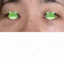 クマ治療 / 脂肪注入（肌） X CLINIC 大阪院 DAY 1 サムネイル用