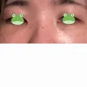 クマ治療 / 脂肪注入（肌） X CLINIC 大阪院 DAY 2 サムネイル用