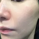 エレクトロポレーション / 毛穴洗浄（ハイドラフェイシャルなど） Re：HADA CLINIC 銀座 DAY 0 サムネイル用