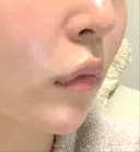 肌ヒアルロン酸注入（たるみ・シワ改善） / ヒアルロン酸注入（唇） TCB東京中央美容外科 中野院 DAY 2 サムネイル用