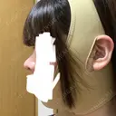 鼻尖形成（切開） / 軟骨移植 MIL CLINIC OSAKA DAY 85 サムネイル用