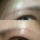 眉下切開 湘南美容クリニック 赤羽院 DAY 100 サムネイル用