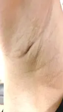 豊胸（シリコンバッグ） ジョウクリニック 那覇院 DAY 19 サムネイル用