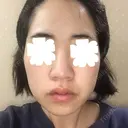 鼻尖形成（切開） / 小鼻縮小（切開） / その他（鼻） / 軟骨移植 JUN CLINIC DAY 61 サムネイル用