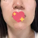 エレクトロポレーション / 毛穴洗浄（ハイドラフェイシャルなど） / ピコスポット 日比谷セントラルクリニック DAY 0 サムネイル用