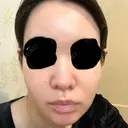 イオン導入 / 毛穴洗浄（ハイドラフェイシャルなど） oneUPclinic DAY 3 サムネイル用