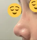 鼻尖形成（切開） / 軟骨移植 / 鼻修正 / 鼻柱下降・鼻唇角形成（猫手術） 東京シンデレラ美容外科 池袋院 DAY 46 サムネイル用