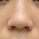 小鼻縮小（切開） 渋谷の森クリニック DAY 7 サムネイル用