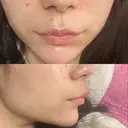 ボトックス（人中） Taide Suenaga Clinic（タイデスエナガクリニック） DAY 0 サムネイル用