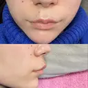 ボトックス（人中） Taide Suenaga Clinic（タイデスエナガクリニック） DAY 1 サムネイル用