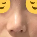 鼻尖形成（切開） / 軟骨移植 / 鼻修正 / 鼻柱下降・鼻唇角形成（猫手術） 東京シンデレラ美容外科 池袋院 DAY 47 サムネイル用