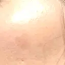 エレクトロポレーション / 毛穴洗浄（ハイドラフェイシャルなど） / ピコスポット 日比谷セントラルクリニック AFTER サムネイル用