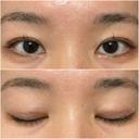 二重埋没 オアシス美容外科 DAY 16 サムネイル用