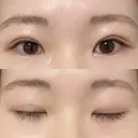 二重埋没 東京シンデレラ美容外科 大宮院 DAY 4 サムネイル用