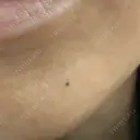 アートメイク（ほくろ） 新宿クレアクリニック AFTER サムネイル用