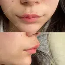 ボトックス（人中） Taide Suenaga Clinic（タイデスエナガクリニック） DAY 3 サムネイル用