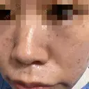 その他（肌） / 美肌レーザー / シミ取りレーザー / 美白レーザー / ピコスポット AURORA CLINIC（オーロラクリニック）新宿院 AFTER サムネイル用