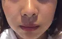 ガミースマイル手術 / 脂肪溶解注射（顔） 湘南美容クリニック 浜松院 DAY 0 サムネイル用