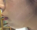 ガミースマイル手術 / 脂肪溶解注射（顔） 湘南美容クリニック 浜松院 DAY 0 サムネイル用