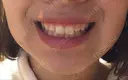 ガミースマイル手術 / 脂肪溶解注射（顔） 湘南美容クリニック 浜松院 DAY 0 サムネイル用