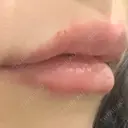 ヒアルロン酸注入（唇） LIKI CLINIC KOBE AFTER サムネイル用