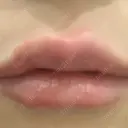 ヒアルロン酸注入（唇） LIKI CLINIC KOBE DAY 0 サムネイル用