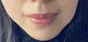 ボトックス（口角） ルラ美容クリニック 名古屋本院 DAY 6 サムネイル用