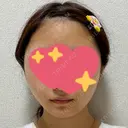 糸リフト / ボトックス（エラ・小顔） TCB東京中央美容外科 仙台駅前院 DAY 0 サムネイル用