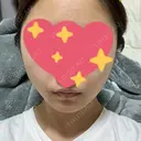 糸リフト / ボトックス（エラ・小顔） TCB東京中央美容外科 仙台駅前院 AFTER サムネイル用