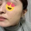 ピコスポット 日比谷セントラルクリニック DAY 9 サムネイル用