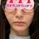 糸リフト / 脂肪吸引（顔） 東京美専クリニック DAY 13 サムネイル用