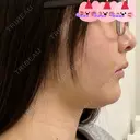 糸リフト / 脂肪吸引（顔） 東京美専クリニック DAY 13 サムネイル用