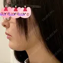 糸リフト / 脂肪吸引（顔） 東京美専クリニック DAY 13 サムネイル用