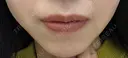 ボトックス（口角） ルラ美容クリニック 名古屋本院 DAY 7 サムネイル用