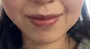 ボトックス（口角） ルラ美容クリニック 名古屋本院 DAY 8 サムネイル用