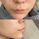 ボトックス（人中） Taide Suenaga Clinic（タイデスエナガクリニック） DAY 6 サムネイル用